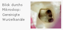 Behandlung unter Lupenbrille: Desinfektion der feinen Wurzelkanäle mit Spülflüssigkeit und medikamentöser Einlage – schonende, präzise Endodontie in Seelze bei Hannover.