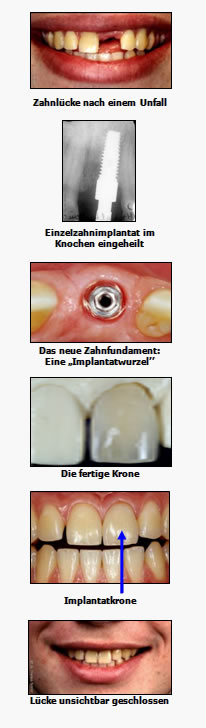 Darstellung eines Zahnimplantats aus Titan im Kieferknochen – moderne Implantatbehandlung in der Zahnarztpraxis Farida Rauschning in Seelze bei Hannover. Das Implantat ersetzt die natürliche Zahnwurzel und bildet die stabile Basis für eine Krone, um Zahnlücken funktionell und ästhetisch zu schließen. Die Behandlung erfolgt unter lokaler Betäubung und orientiert sich an aktuellen implantologischen Standards.